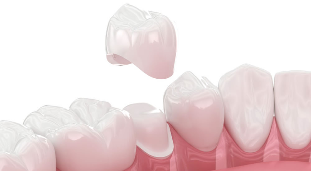 セラミック治療が保険適用外になる理由