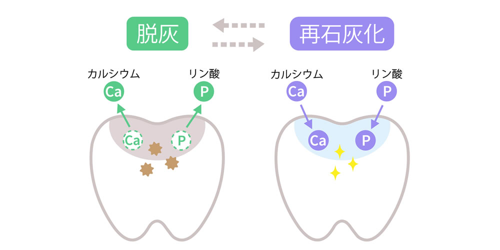 虫歯を防ぐ歯に再石灰化