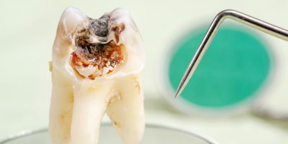 虫歯が再発する原因