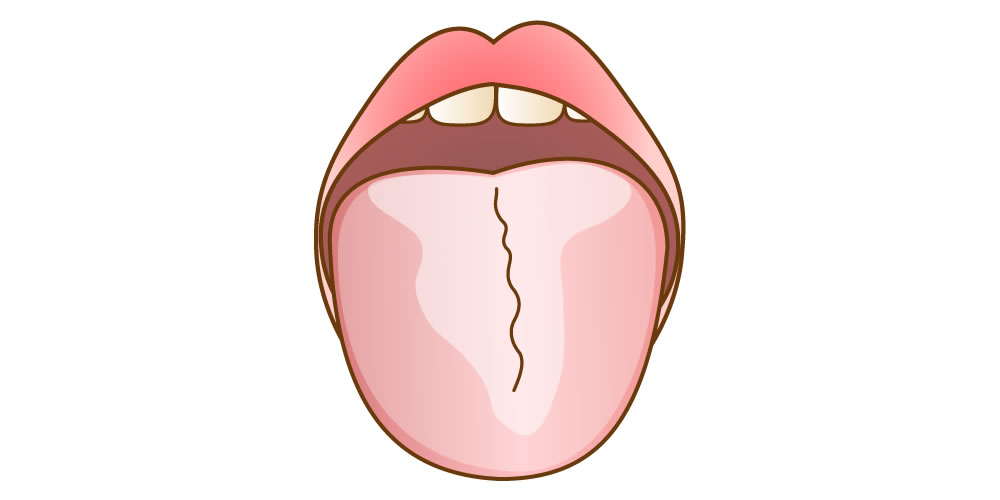 舌が白くなる原因について