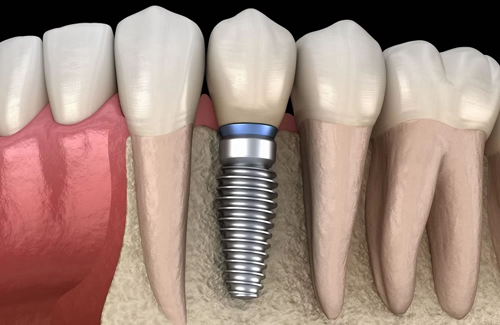 インプラントが骨と結合する理由