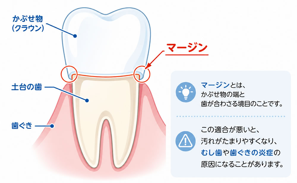 かぶせ物の「マージン」