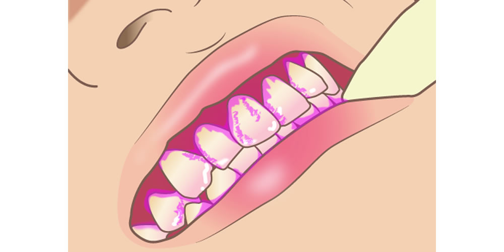 虫歯治療でう蝕検知液を使用する目的について