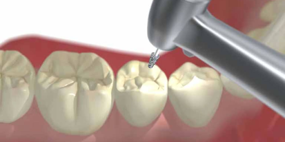 小さな虫歯でも削る必要がある状態について