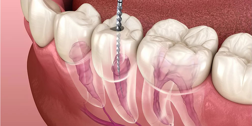 歯の神経の治療(根管治療)