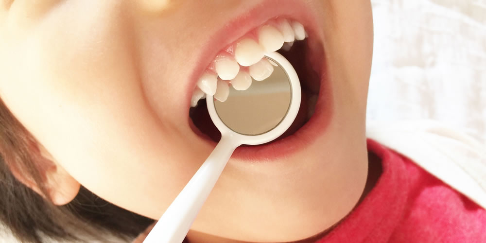 子どもの虫歯予防におすすめのシーラント