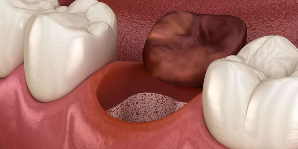 親知らずの抜歯後に注意するドライソケット