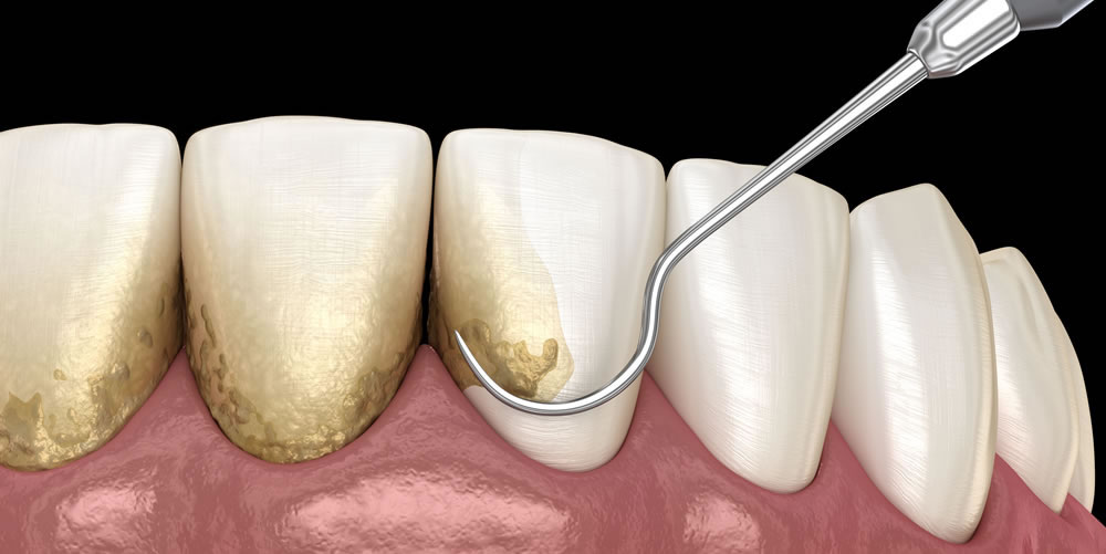 白い歯石と黒い歯石の特徴と原因