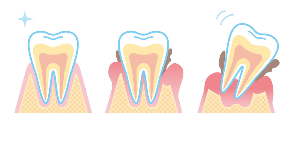 歯周病になりやすい人の特徴について