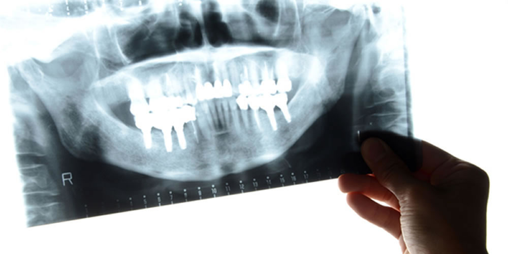 インプラント治療で歯がない期間と仮歯を入れる理由