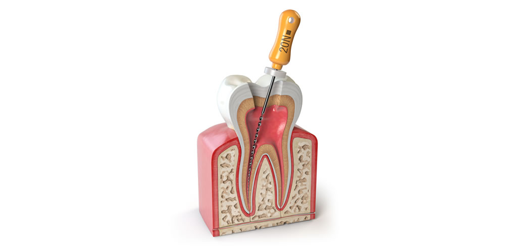 歯の神経を抜く根管治療に伴う痛みの原因