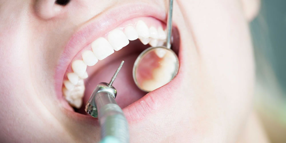 一度治療した虫歯が再発しやすい原因について