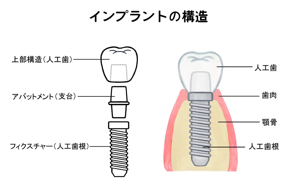 インプラントの構造