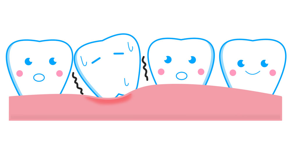 歯がグラグラする主な原因について