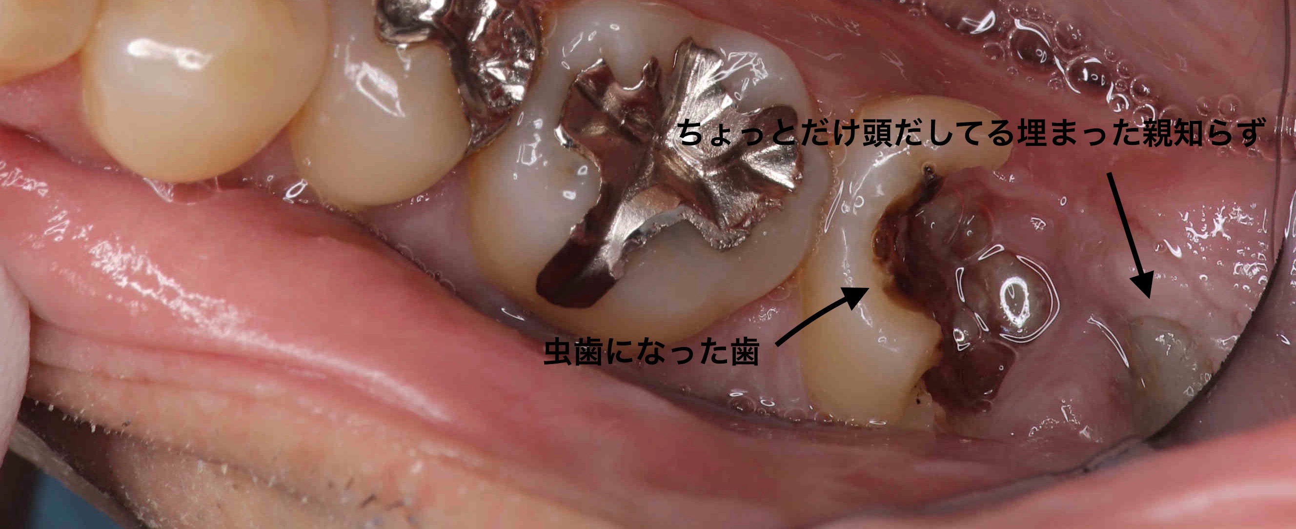 親知らず 虫歯 欠け た