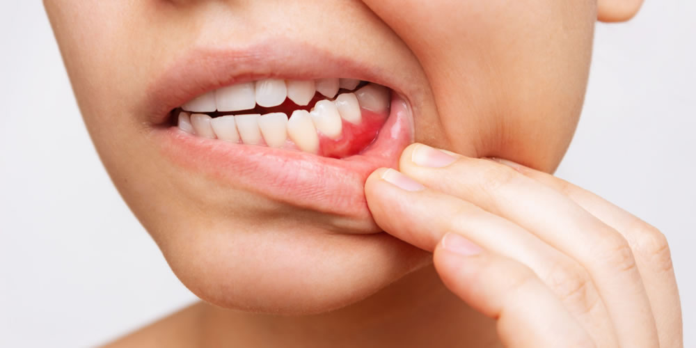 歯茎の腫れや痛みを感じる際の応急処置・対処法