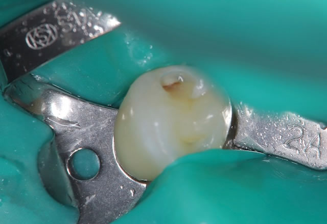 歯の内部虫歯