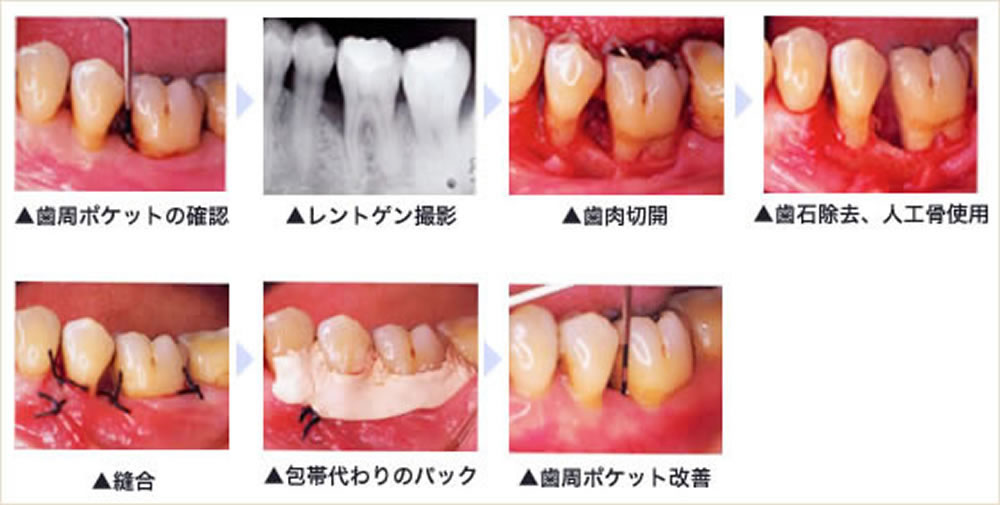 重度歯周病